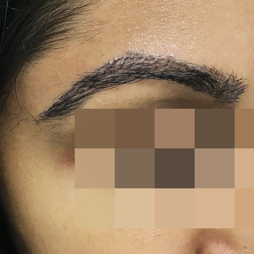 ba-patientE-eyebrows-6daysafter